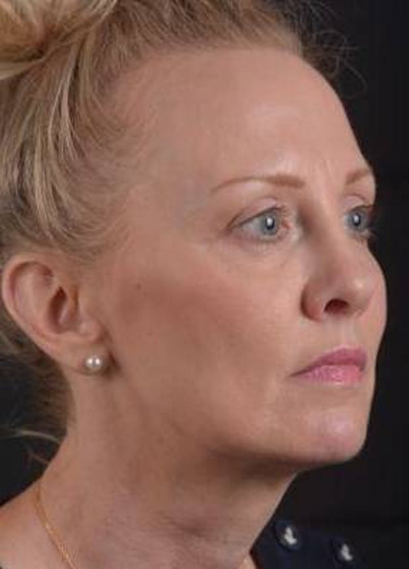 Blepharoplasty Before & After Gallery - Patient 214717 - Image 7
