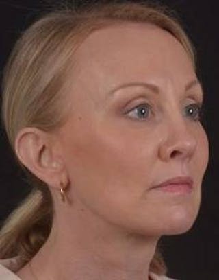 Blepharoplasty Before & After Gallery - Patient 214717 - Image 8