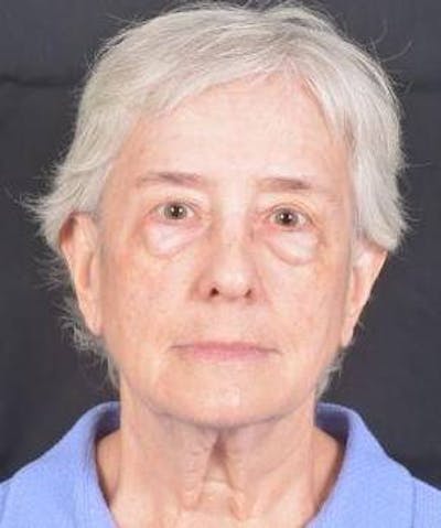 Blepharoplasty Before & After Gallery - Patient 425227 - Image 1