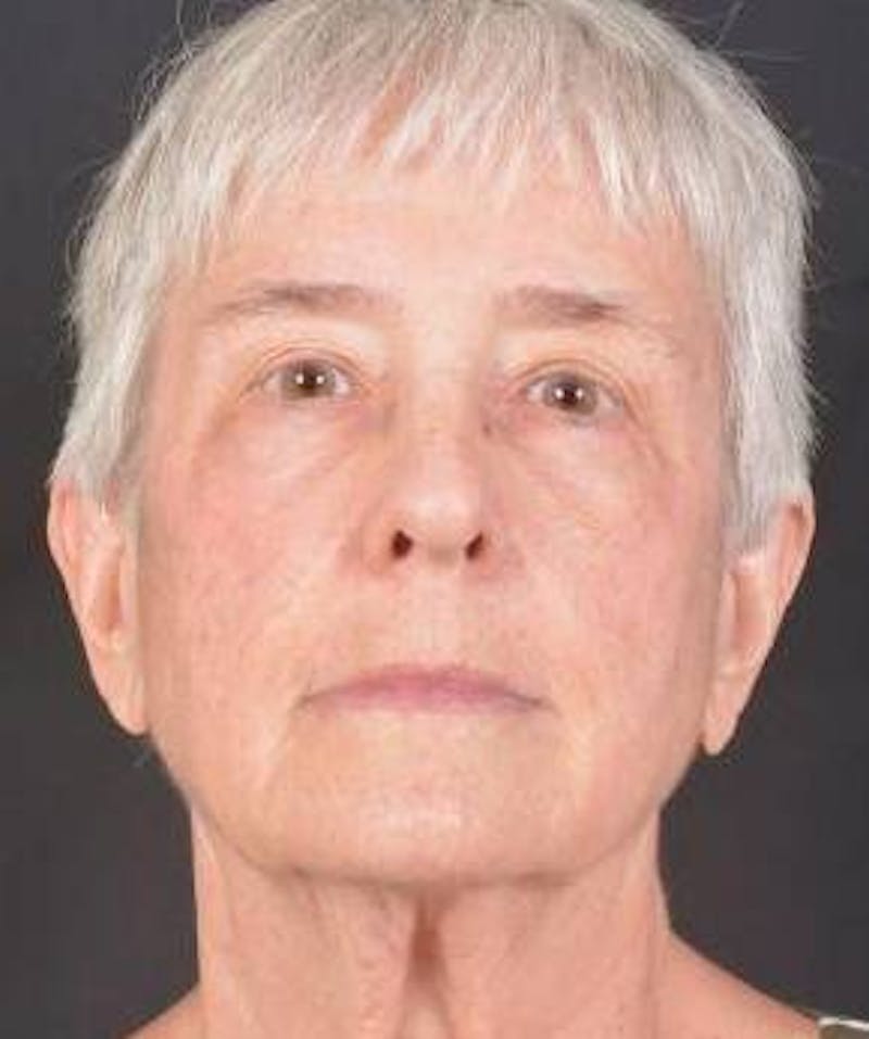 Blepharoplasty Before & After Gallery - Patient 425227 - Image 2