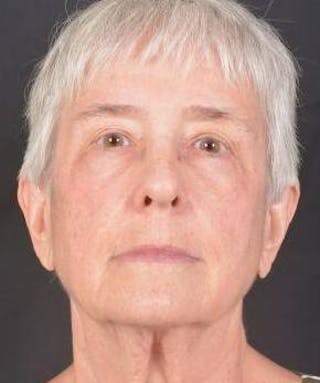 Blepharoplasty Before & After Gallery - Patient 425227 - Image 2