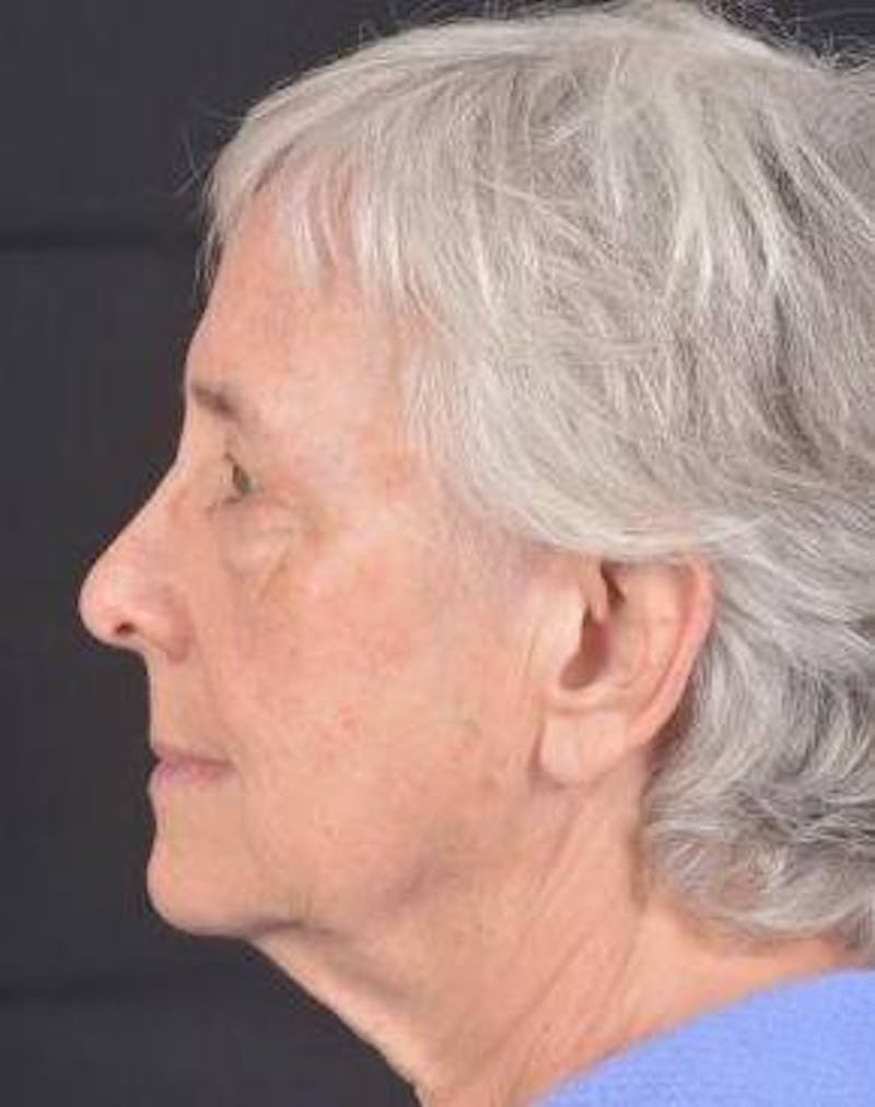 Blepharoplasty Before & After Gallery - Patient 425227 - Image 3