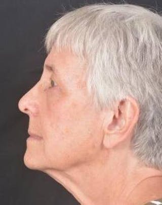 Blepharoplasty Before & After Gallery - Patient 425227 - Image 4