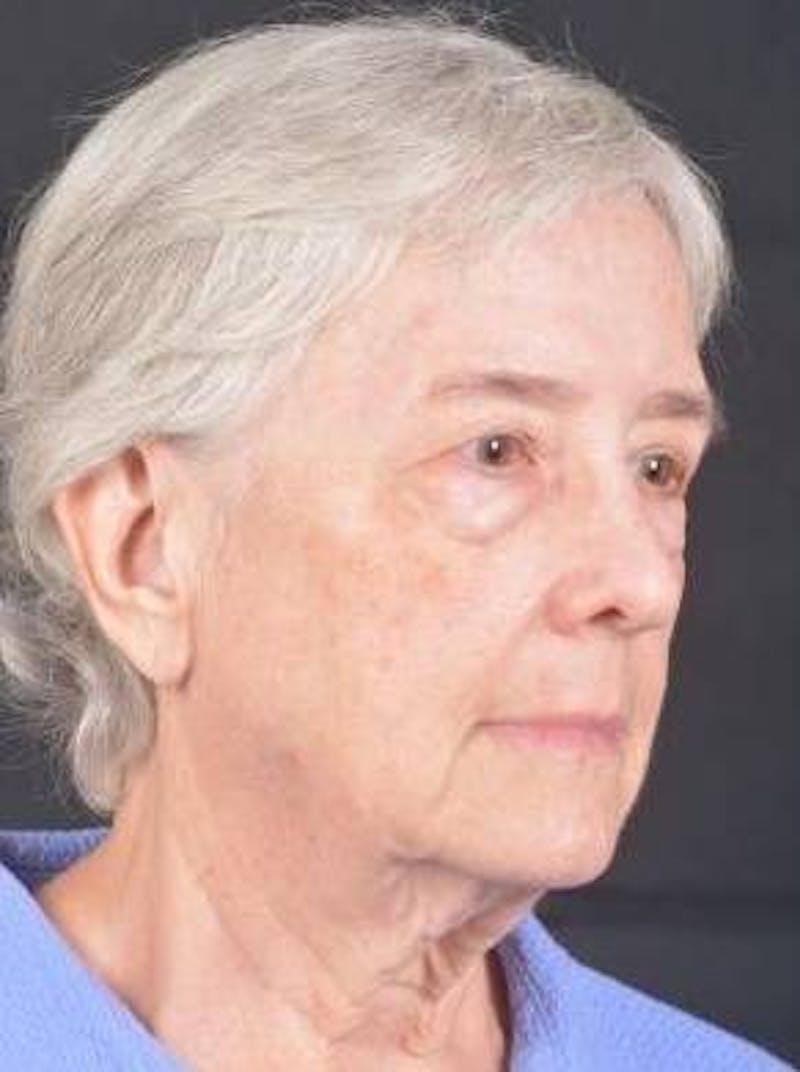 Blepharoplasty Before & After Gallery - Patient 425227 - Image 9