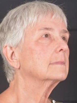 Blepharoplasty Before & After Gallery - Patient 425227 - Image 10