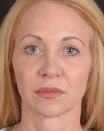 Blepharoplasty Before & After Gallery - Patient 563095 - Image 1