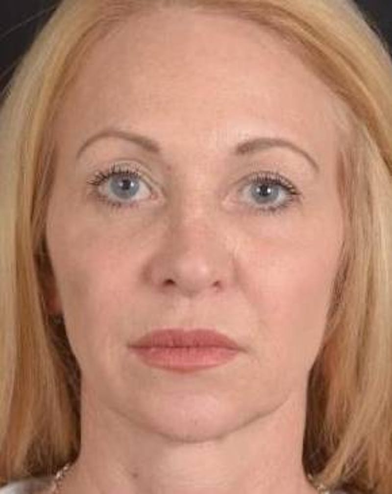 Blepharoplasty Before & After Gallery - Patient 563095 - Image 1