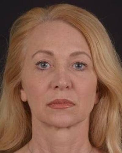 Blepharoplasty Before & After Gallery - Patient 563095 - Image 2