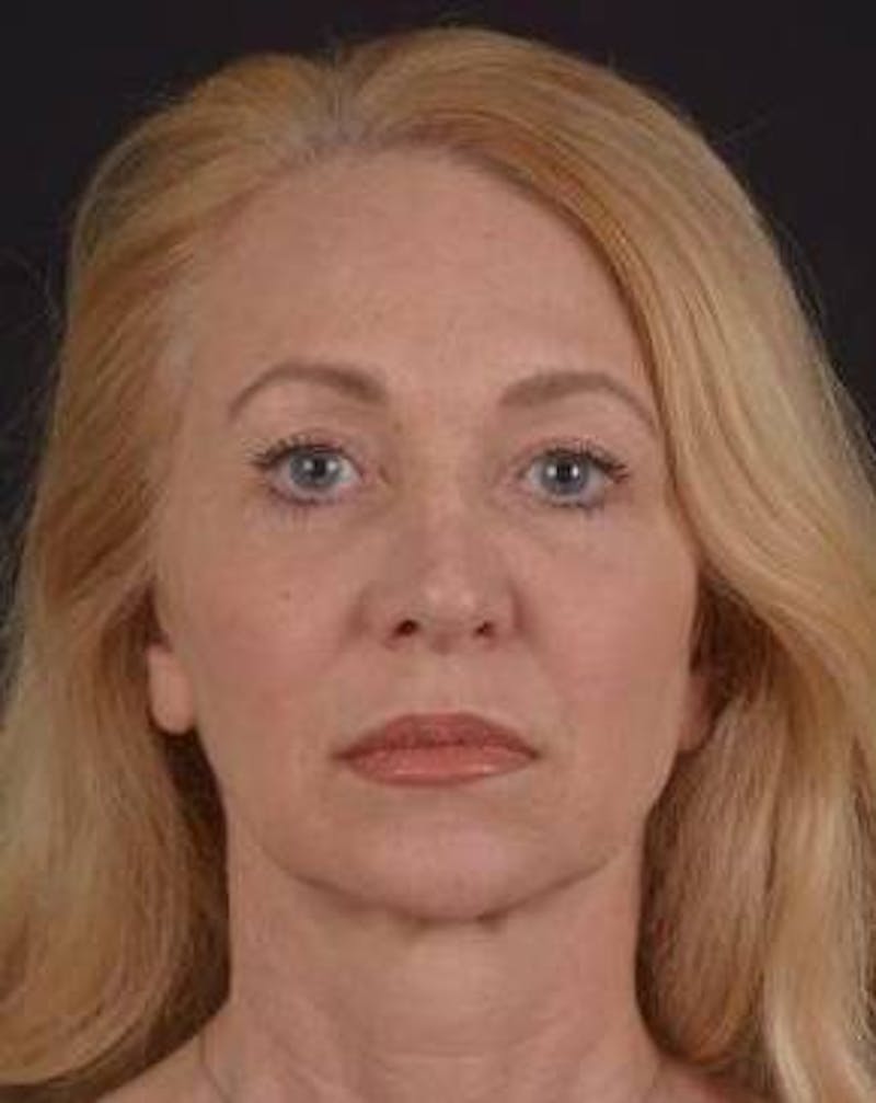 Blepharoplasty Before & After Gallery - Patient 563095 - Image 2