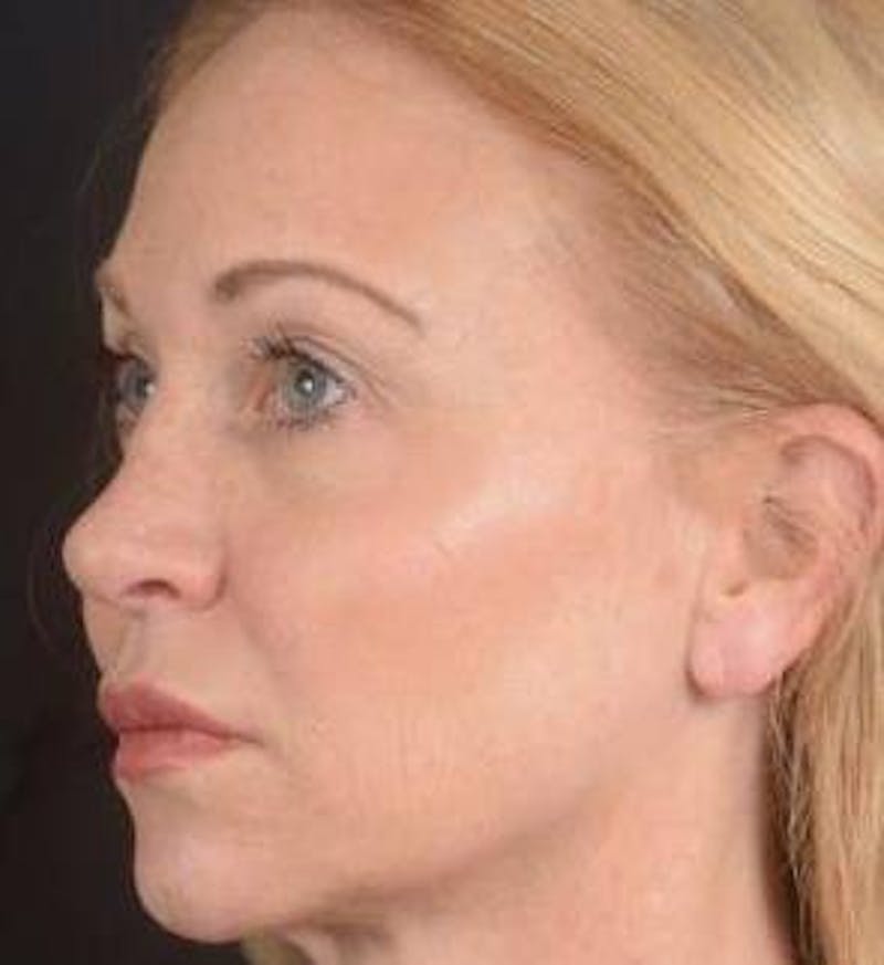 Blepharoplasty Before & After Gallery - Patient 563095 - Image 7