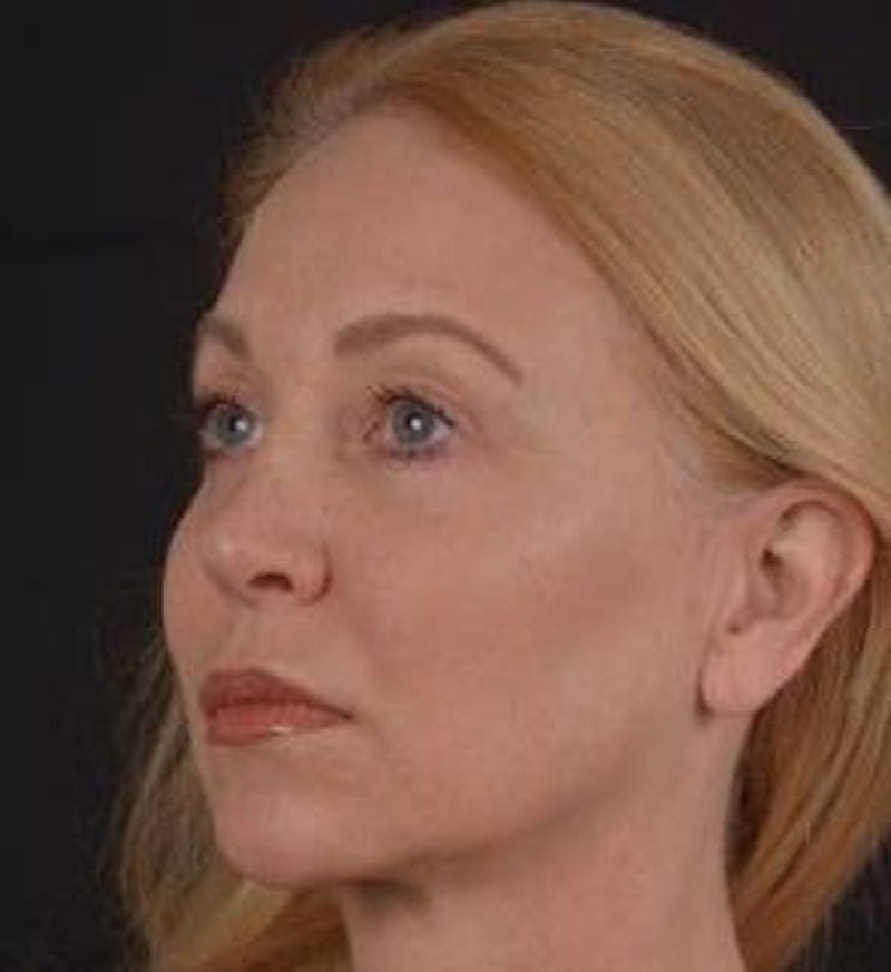 Blepharoplasty Before & After Gallery - Patient 563095 - Image 8