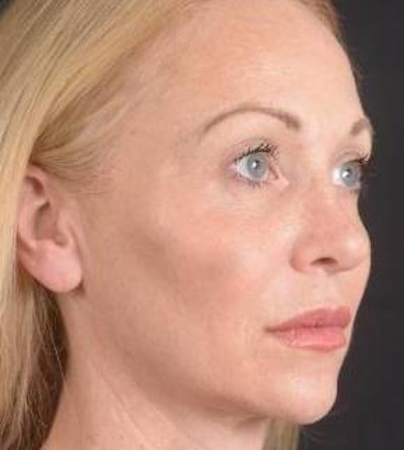 Blepharoplasty Before & After Gallery - Patient 563095 - Image 9