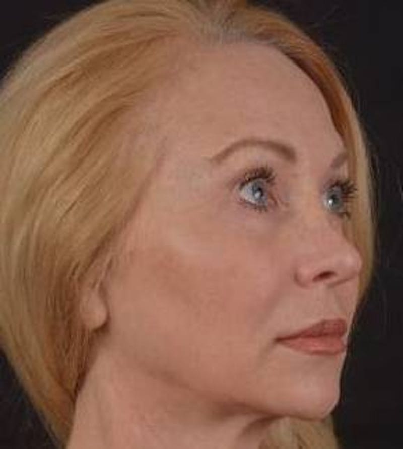 Blepharoplasty Before & After Gallery - Patient 563095 - Image 10