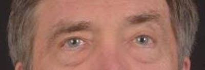 Blepharoplasty Before & After Gallery - Patient 208189 - Image 1