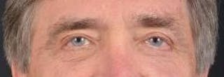 Blepharoplasty Before & After Gallery - Patient 208189 - Image 2