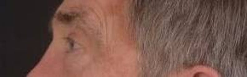 Blepharoplasty Before & After Gallery - Patient 208189 - Image 3