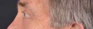 Blepharoplasty Before & After Gallery - Patient 208189 - Image 4