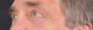 Blepharoplasty Before & After Gallery - Patient 208189 - Image 8