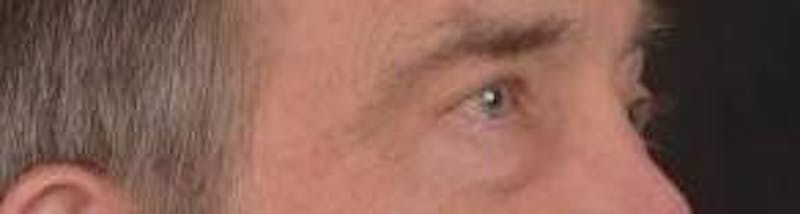 Blepharoplasty Before & After Gallery - Patient 208189 - Image 9