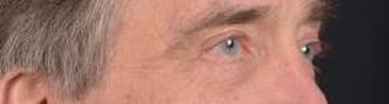 Blepharoplasty Before & After Gallery - Patient 208189 - Image 10