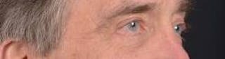 Blepharoplasty Before & After Gallery - Patient 208189 - Image 10