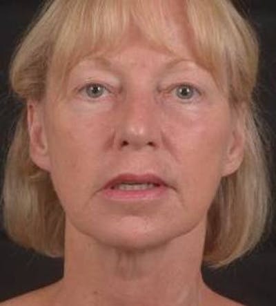 Blepharoplasty Before & After Gallery - Patient 764240 - Image 1