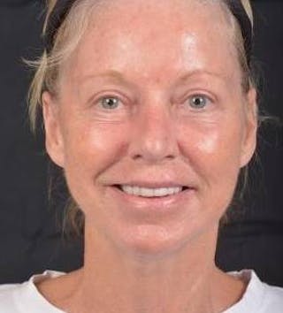 Blepharoplasty Before & After Gallery - Patient 764240 - Image 2