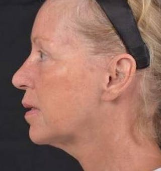 Blepharoplasty Before & After Gallery - Patient 764240 - Image 4