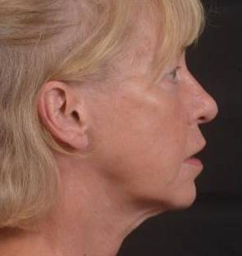 Blepharoplasty Before & After Gallery - Patient 764240 - Image 5