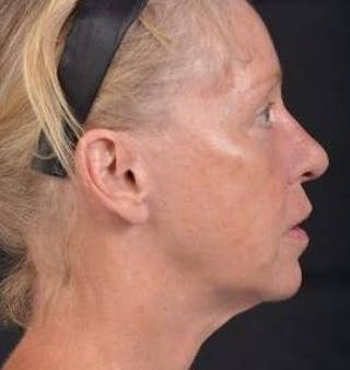 Blepharoplasty Before & After Gallery - Patient 764240 - Image 6