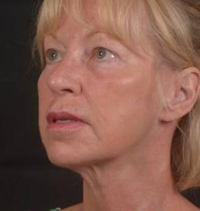 Blepharoplasty Before & After Gallery - Patient 764240 - Image 7