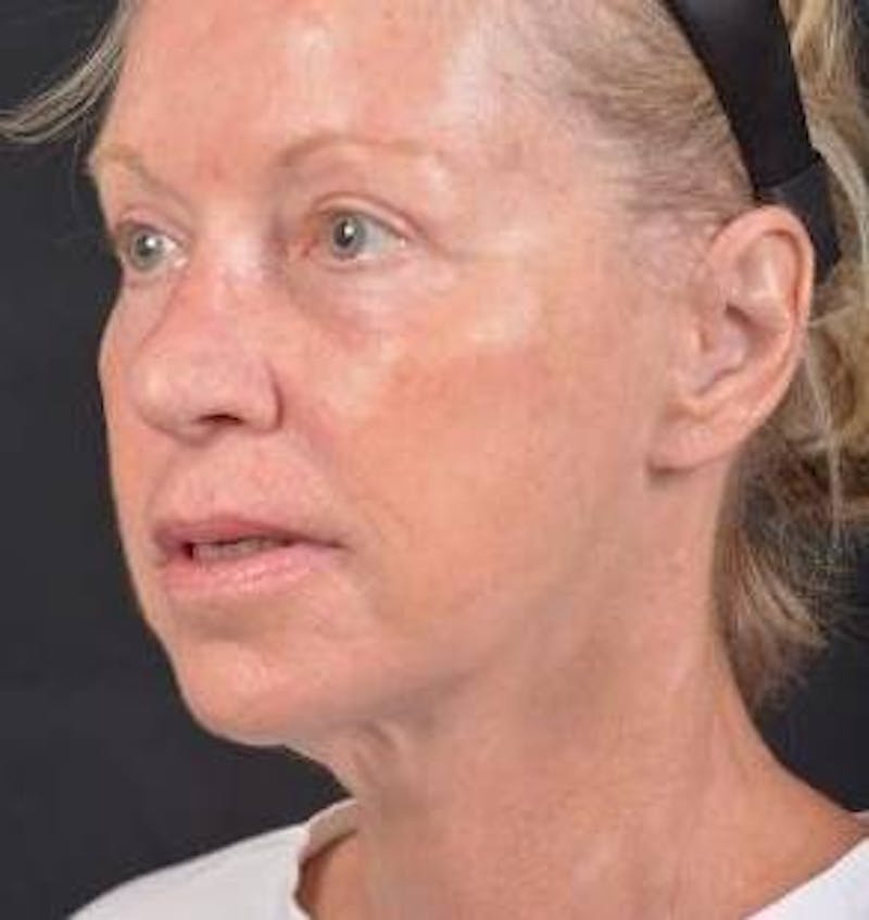 Blepharoplasty Before & After Gallery - Patient 764240 - Image 8