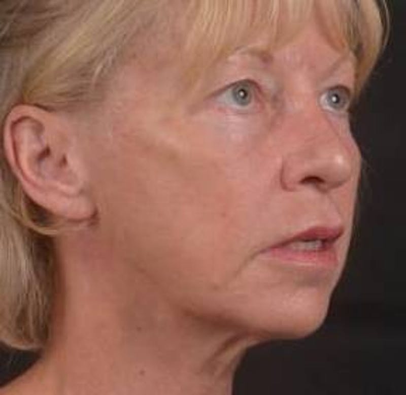 Blepharoplasty Before & After Gallery - Patient 764240 - Image 9