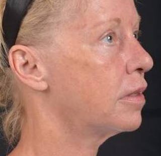 Blepharoplasty Before & After Gallery - Patient 764240 - Image 10