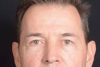 Blepharoplasty Before & After Gallery - Patient 254252 - Image 1