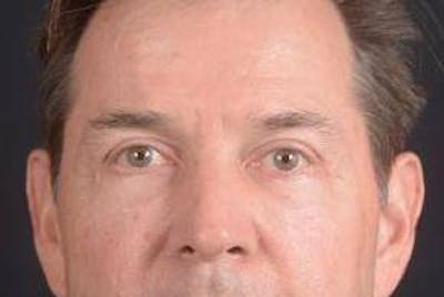 Blepharoplasty Before & After Gallery - Patient 254252 - Image 2