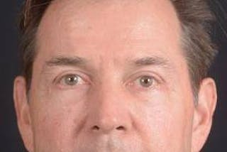 Blepharoplasty Before & After Gallery - Patient 254252 - Image 2