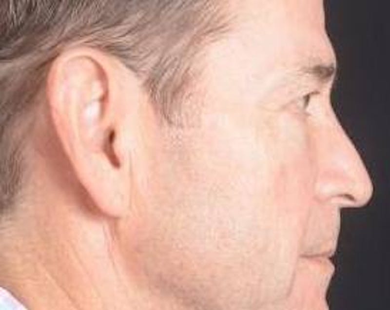 Blepharoplasty Before & After Gallery - Patient 254252 - Image 5