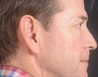 Blepharoplasty Before & After Gallery - Patient 254252 - Image 6