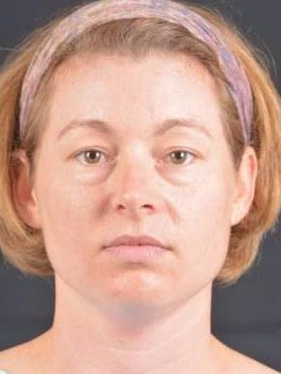 Blepharoplasty Before & After Gallery - Patient 868507 - Image 1