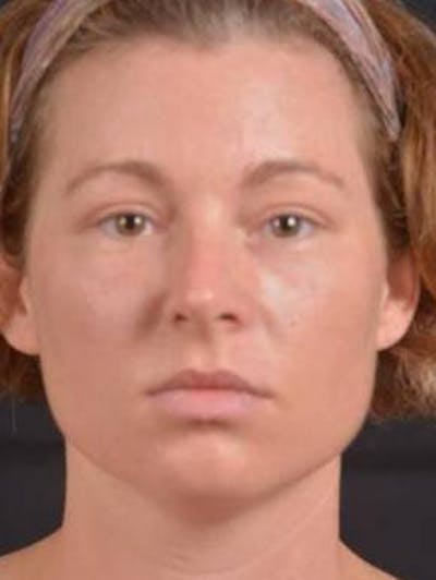 Blepharoplasty Before & After Gallery - Patient 868507 - Image 2