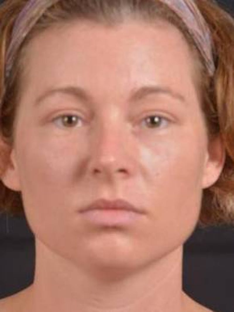 Blepharoplasty Before & After Gallery - Patient 868507 - Image 2