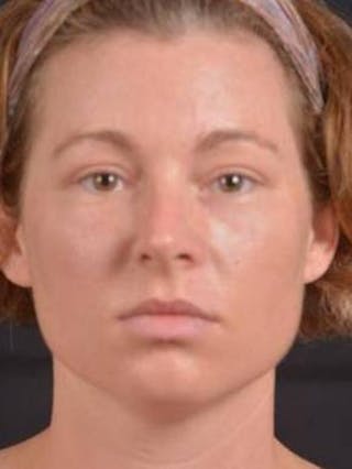 Blepharoplasty Before & After Gallery - Patient 868507 - Image 2