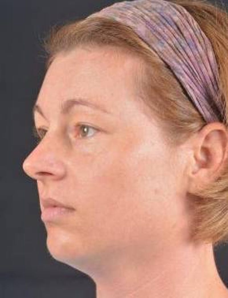 Blepharoplasty Before & After Gallery - Patient 868507 - Image 3