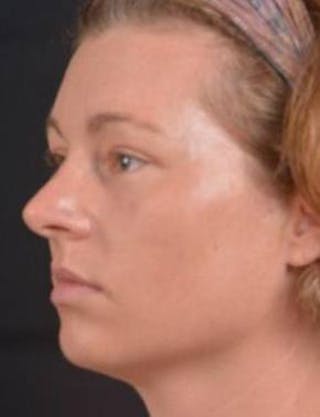 Blepharoplasty Before & After Gallery - Patient 868507 - Image 4