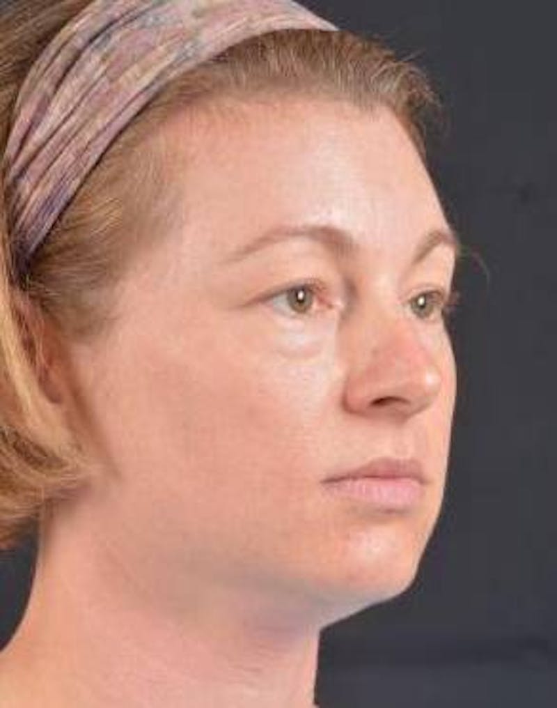 Blepharoplasty Before & After Gallery - Patient 868507 - Image 5