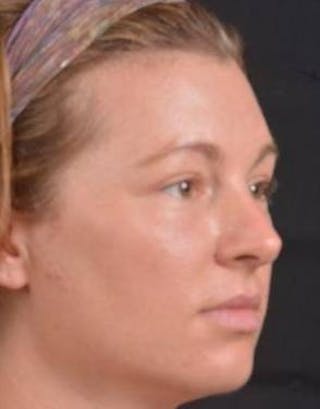 Blepharoplasty Before & After Gallery - Patient 868507 - Image 6