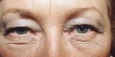 Blepharoplasty Before & After Gallery - Patient 415426 - Image 1