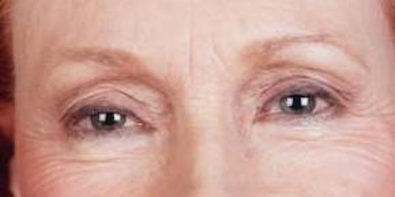 Blepharoplasty Before & After Gallery - Patient 415426 - Image 2