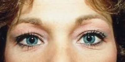 Blepharoplasty Before & After Gallery - Patient 704976 - Image 1